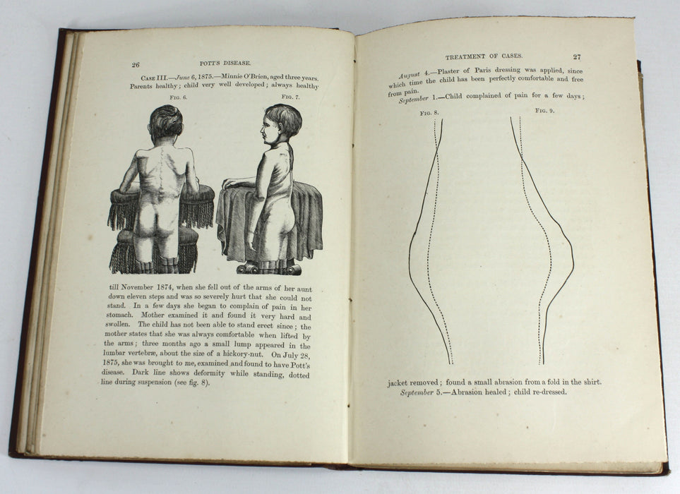 Spinal Disease and Spinal Curvature, by Lewis A Sayre, 1877